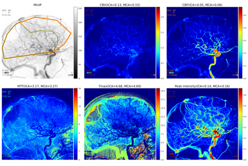 Perfusion maps generated from DSA image sequence