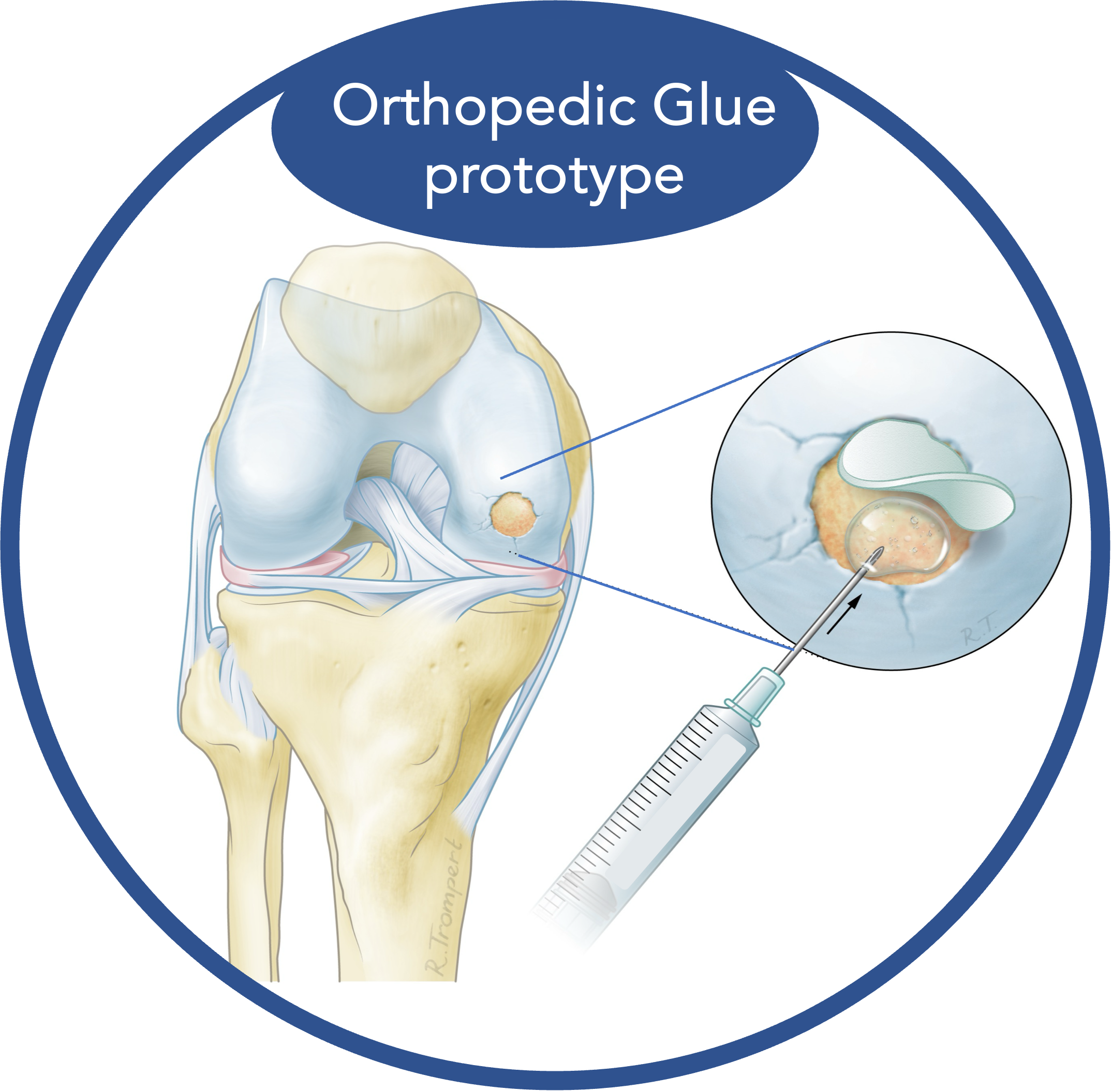 Orthopedic Glue