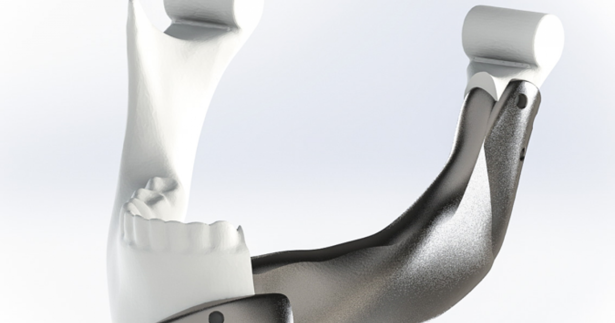 A novel 3D printed titanium jaw implant after partial lower jaw resection |  Health~Holland
