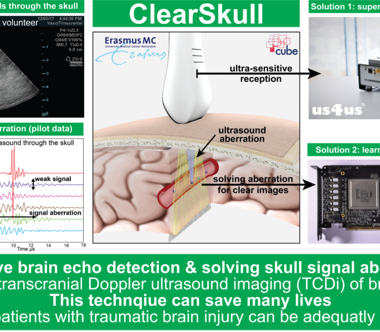 Enabling ultrasound imaging through the skull to see blood flow in the brain