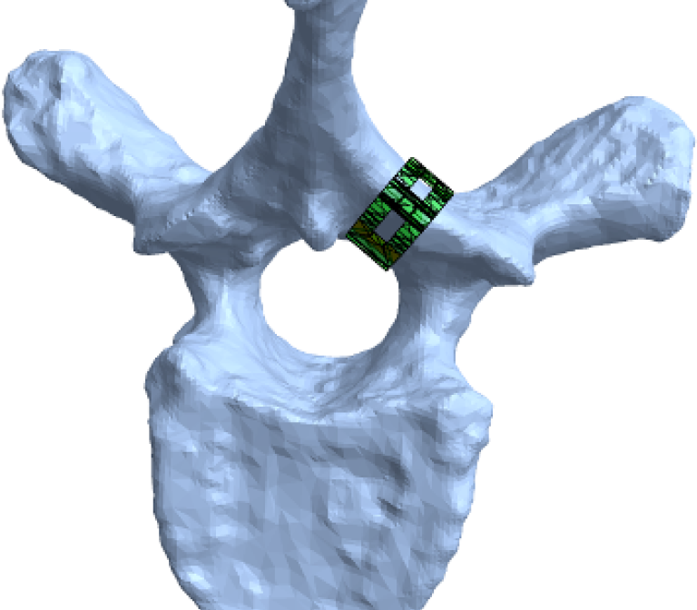 Safe Neurostimulation Against Pain 