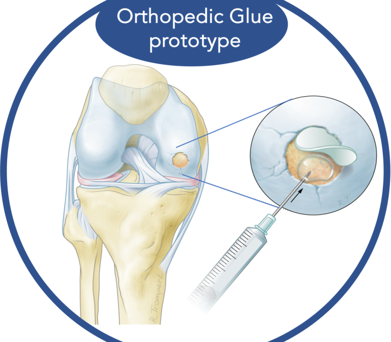 Orthopedic Glue