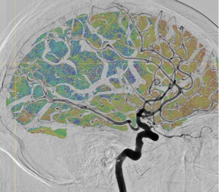 Perfusion maps generated from DSA image sequence