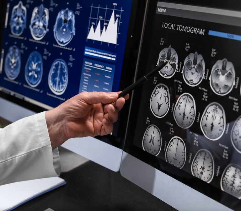 Early detectioN of thromboemboliC sources And smalL vOlume stroke with SpEctral ct