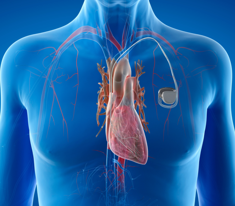 A navigation system to guide placement of cardiac pacemaker leads