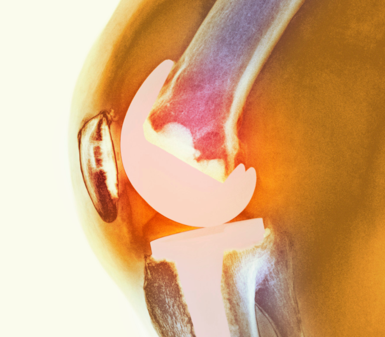 Replacing the knee joint by re-creating the patient’s healthy knee  