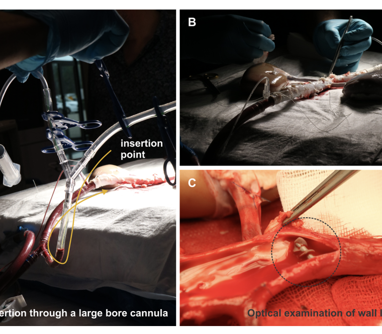 Wireless Clot Retrieval Device for Stroke Treatment