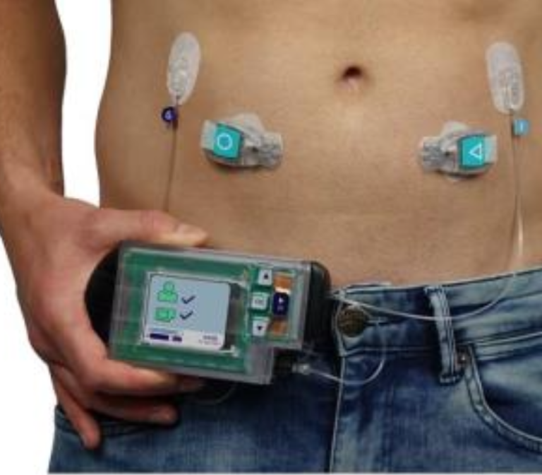 Bihormonal artificial pancreas for post-pancreatectomy glucose control